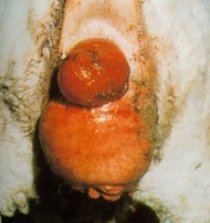 Vaginal Prolapse